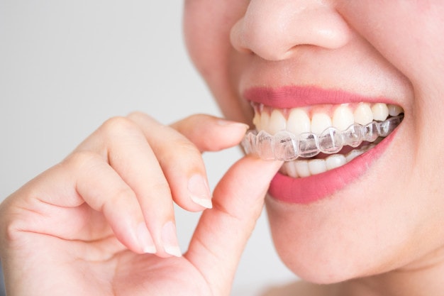 invisalign_43937-94.jpg