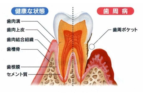 歯周病