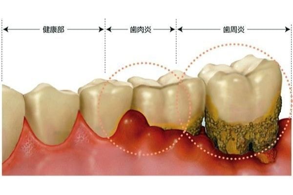 歯周病進行